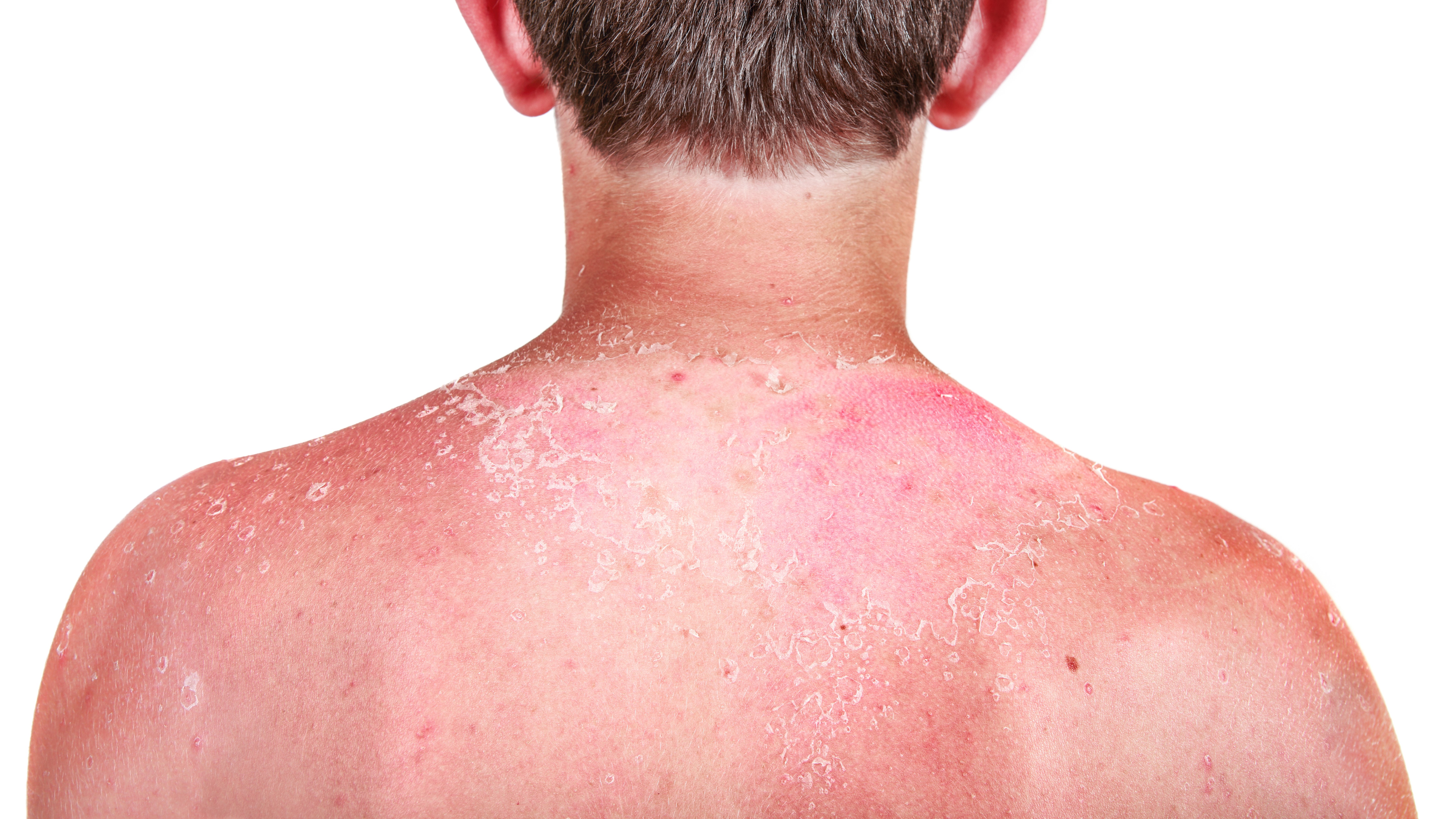 Sonnenbrand am Rücken durch UV-Strahlung